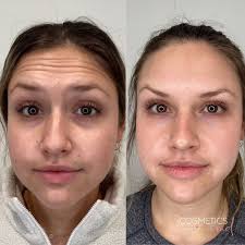 Expert Botox Treatment in Peabody, MA