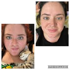 What skin care products and routines are recommended for blackheads and red  skin?