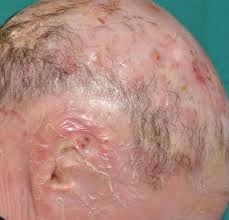 Image result for Ichthyosis