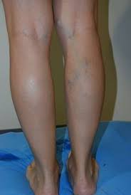 Varis Olusumunu Engelleyen Mucize Bitki Tavsanmemesi Varis Saglik Bakim Saglik