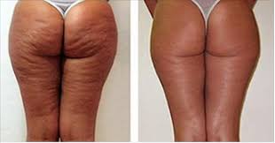 La caféine contenue dans le marc de café est l'agent principale qui permet de favoriser l'élimination de la cellulite et des amas graisseux. Buzzfil Blog Ce Qu Elle A Utilise Pour Faire Disparaitre Sa Cellulite Se Trouve Probablement Dans Votre Poubelle