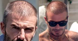 Stempiatura fisiologica a 20 anni. I Capelli Di David Beckham Si E Fatto Un Trapianto