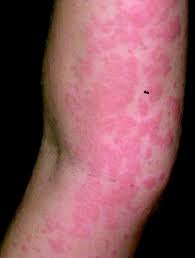 Along with its needed effects, cephalexin (the active ingredient contained in keflex) may cause some unwanted effects. 8 Management Of Allergy Rashes And Itching Emergency Medicine Journal