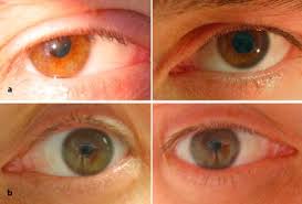 Botulinum typ a, typ b und typ e immunisiert wurden, gewonnen. Botulismus Durch Raucherlachsverzehr Springerlink