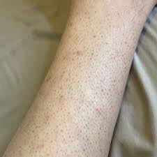 Leg laser hair removal targets the pigment in your hair follicle, and since waxing removes the whole hair shaft, it will be difficult for the laser to correctly pinpoint the hairs it needs to eliminate. Strawberry Legs Would Hair And Scar Removal Improve The Look Of My Legs Photo