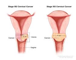 Image result for Cervical Cancer