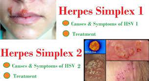 When you have an outbreak of hsv1, it is painful, visible to everyone and damned annoying. How To Get Rid Of Herpes Outbreak Overnight Groundpress By Alisa Joy Medium