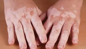 This may persist for several days. Hypopigmentation Causes Types And Treatment