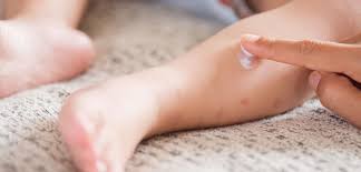 Hand Fuss Mund Krankheit Ansteckung Symptome Und Behandlung