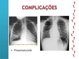 Abcesso pulmonar (temos observado muitos casos de abcessos. Pneumonia Pediatria