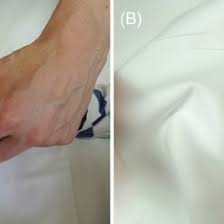 What is capillary fill time? Pdf How To Use Capillary Refill Time