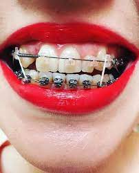 Braces Metalbraces Girlswithbraces Elastics Springs Clearbraces Dental Braces Braces Girls Braces Colors