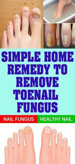 Simple Home Remedy To Remove Toenail Fungus Toenail Fungus Toenail Fungus Remedies Nail Fungus