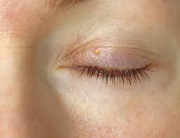 Image result for xanthelasma of eyelid