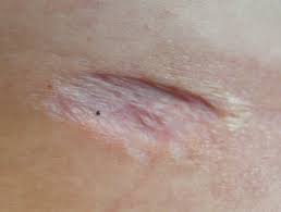 No difference in healing or cosmesis in 4 mm or. Risks And Complications Of Skin Surgery Dermnet Nz