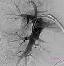 Klinická klasifikace rozeznává sedm kategorií plicní hypertenze, viz přehled 1 (2). Centrum Pro Plicni Hypertenzi Ii Interni Klinika Kardiologie A Angiologie 1 Lf Uk A Vfn