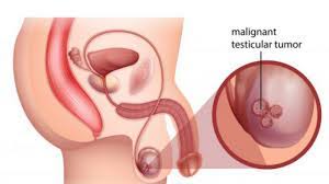 The stages of testicular cancer are indicated by roman numerals that range from 0 to iii, with the lowest stages indicating cancer that is limited to the area around the testicle. Testicular Cancer Signs Symptoms And Treatment Options Onco Com