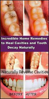 Incredible Home Remedies To Heal Cavities And Tooth Decay Naturally Face Errors Tooth Decay Remedies Heal Cavities Reverse Cavities