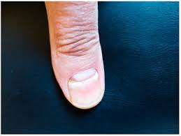 Image result for Beau lines feet