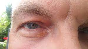 Hi Weiss Jemand Was Dieser Orange Fleck Sein Konnte Unter Dem Auge Medizin