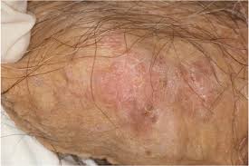 Image result for penis mycosis symptoms
