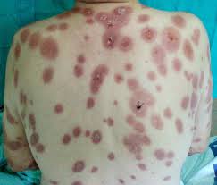 For some people, hepatitis b infection becomes chronic, meaning it lasts most adults with hepatitis b recover fully, even if their signs and symptoms are severe. 8 Penyakit Jangkitan Seksual Std