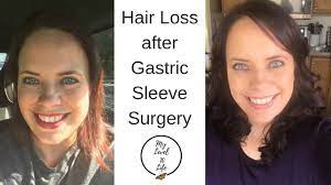 It starts suddenly but seldom contiunes for more than six months. Hair Extensions Hair Loss After Weight Loss Surgery Vsg Youtube