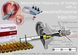 Menieres An Inner Ear Journey Reduce The Frequency Of Vertigo Attacks With A Dexamethasone Steroid Injection Tinnitus Cure Vertigo Treatment Vertigo