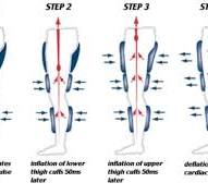 Enhanced External Counter Pulsation (EECP) | University of ...