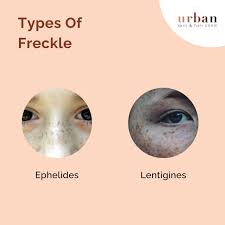 Image result for Freckled skin