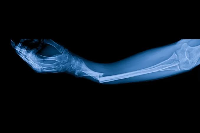 What to Do Immediately After a Fracture | First Aid Guide | Spica Hospitals