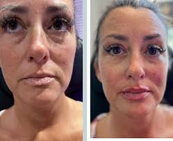 Phyllis Clare RN, BSN (@phoebeglow_aesthetics) • Instagram photos and videos