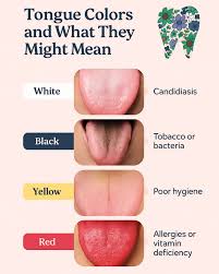 Image result for yellow tongue infection