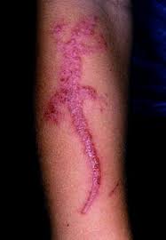 Image result for dermatitis contacta toxica