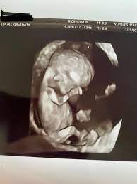10w3d doppler and US - June 2020 Babies | Forums | What to Expect