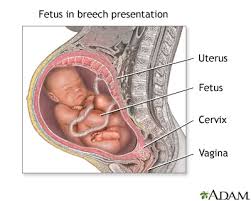 But athey told me that my baby was breached. Is Baby In A Breech Position How To Tell What To Do