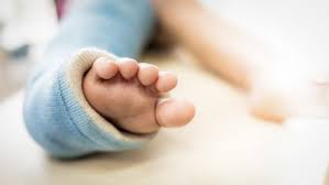 The foot points down and inwards, and the soles of the feet face each other. Clubfoot In Newborns Causes Symptoms Diagnostics Schoen Clinic