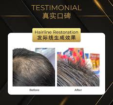 The trouble is, female pattern baldness causes thin hair all over, so good donor sites may be limited. Olivia Thinning Hair Scalp Wash 250ml For Hair Loss Alpro Pharmacy