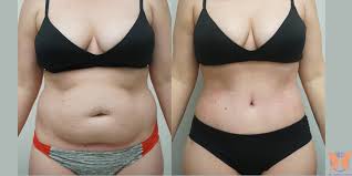 Image result for Liposuction