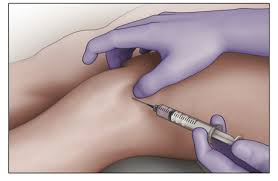 Image result for Knee Joint Injection