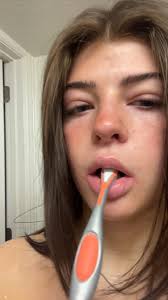 Swollen Eyelids Mono