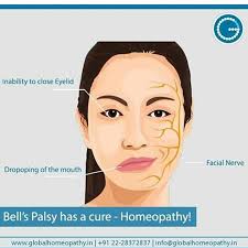 Bell's palsy is a condition where one side of your face droops or feels weak. Eka Ekanrptryni Twitter