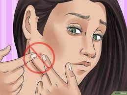 How To Get Rid Of A Zit Overnight (With Pictures) - Wikihow | Zits, Pimples  Overnight, Pimples