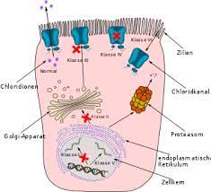 Hilfe und informationen für menschen mit mukoviszidose / cystische fibrose (cf) ✓ forschungsförderung ✓ jetzt informieren. Mukoviszidose Wikipedia