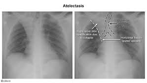 Image result for Atelectasis