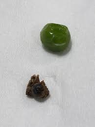 8mm Kidney Stone I Passed This Morning Mildlyinteresting