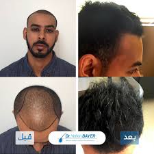 قبل وبعد زراعة الشعر Incoming Call Screenshot