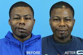 When it reaches this point, your eye doctor may suggest having cataract surgery. Before And After Facial Plastic Surgery Washington University