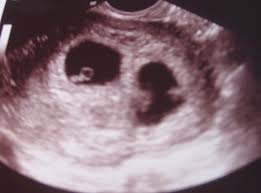 We did not find results for: Day 1 How I Found Out I Was Having Twins Hidden Glory