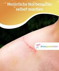 Besser Gesund Leben Machen Narbensalbe Naturliche Selber Naturliche Narbensalbe Selber Machen Narben Auf Der Haut Empfinden Di